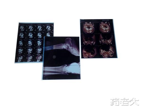 醫(yī)用藍光膠片招商