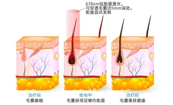 “艾博拉”半導(dǎo)體激光生發(fā)儀、全國招商代理、加盟