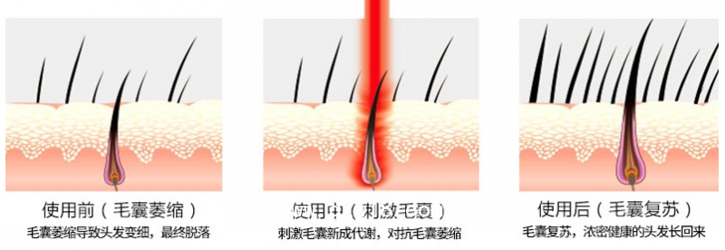 高能半導(dǎo)體激光祛脂生發(fā)儀周期多少