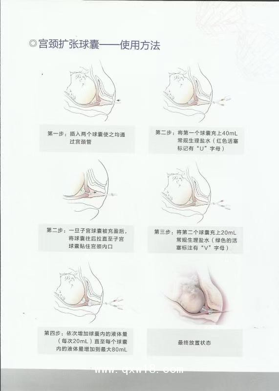 一次性子宮頸球囊導管引產(chǎn)包