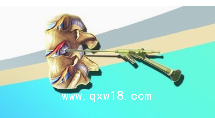 德國ASAP脊柱內(nèi)窺鏡及手術器械