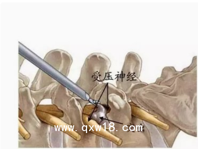 德國ASAP脊柱內(nèi)窺鏡及手術器械