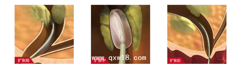 廠家供應(yīng)輸尿管擴張球囊導(dǎo)管