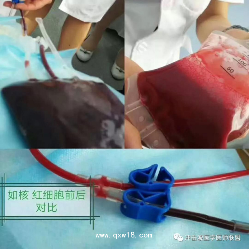 臭氧自體血血袋、三氧自體血血袋、一次性血袋