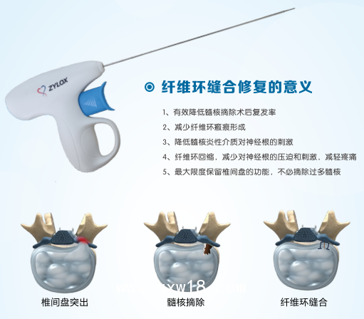 一次性使用纖維環(huán)縫合器市場(chǎng)推廣