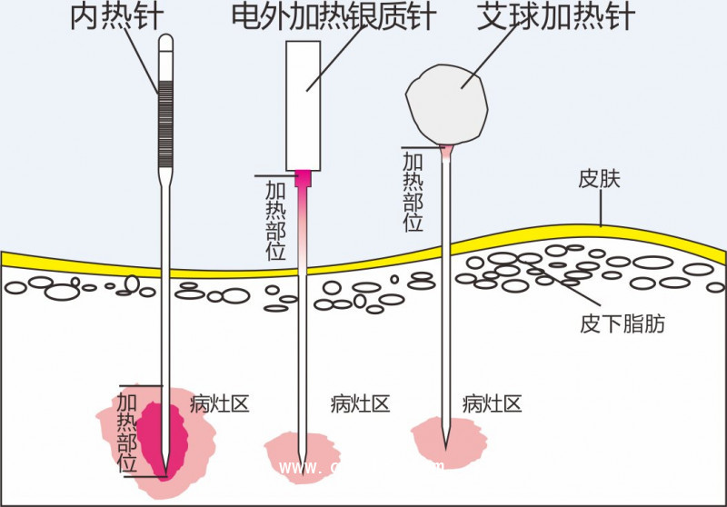 百士康針灸針1.1mm*120mm 內(nèi)熱針式全國招商