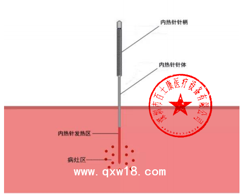 內(nèi)熱針治療儀 深圳百士康廠家 內(nèi)熱針福建浙江代理