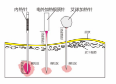 內(nèi)熱針針具、銀質(zhì)針設(shè)備 內(nèi)熱針治療儀